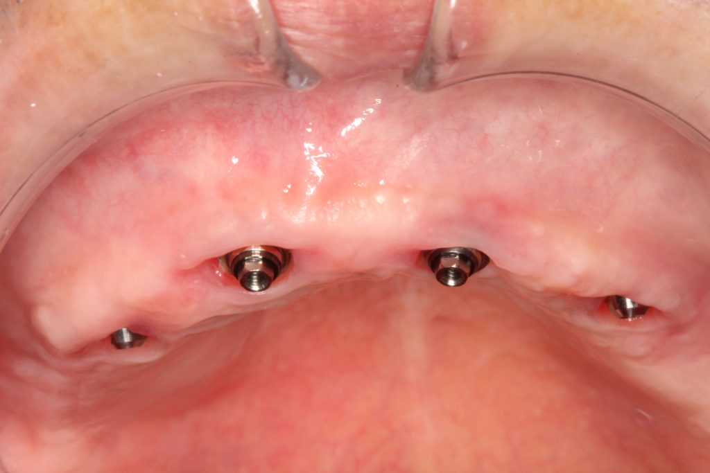 The soft tissue state with abutments before impression for full-arch implant reconstruction