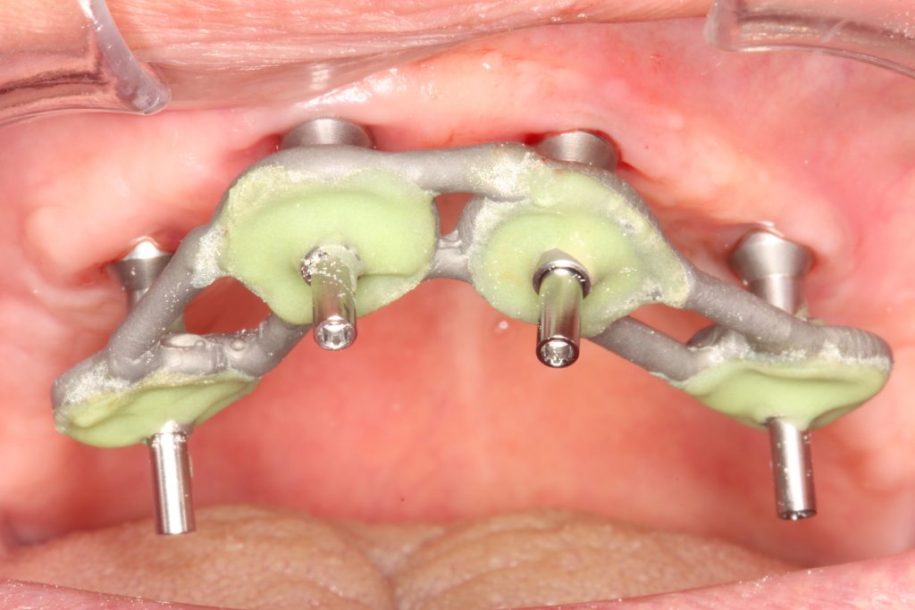 Full-arch implant reconstruction using a conventional analog impression where the impression copings are rigidly splinted