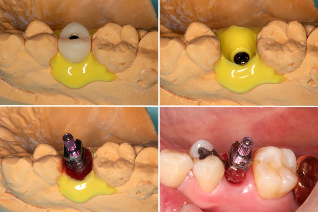 Conventional impression using the customized impression coping for ideal final restoration contours