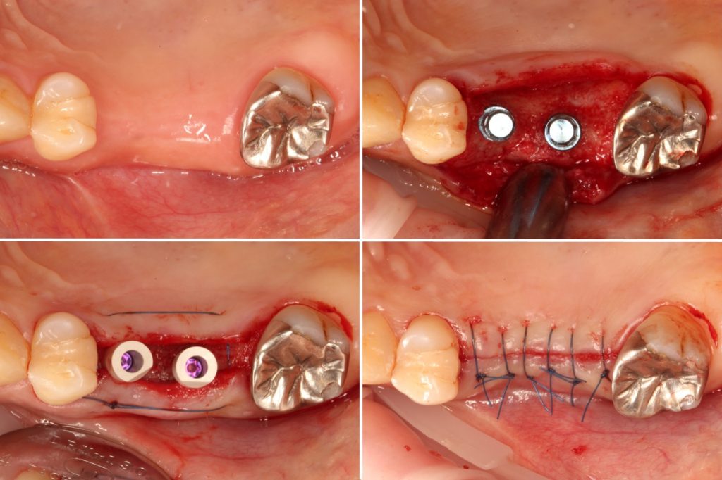 Taking an impression for provisional restoration immediately after implant placement