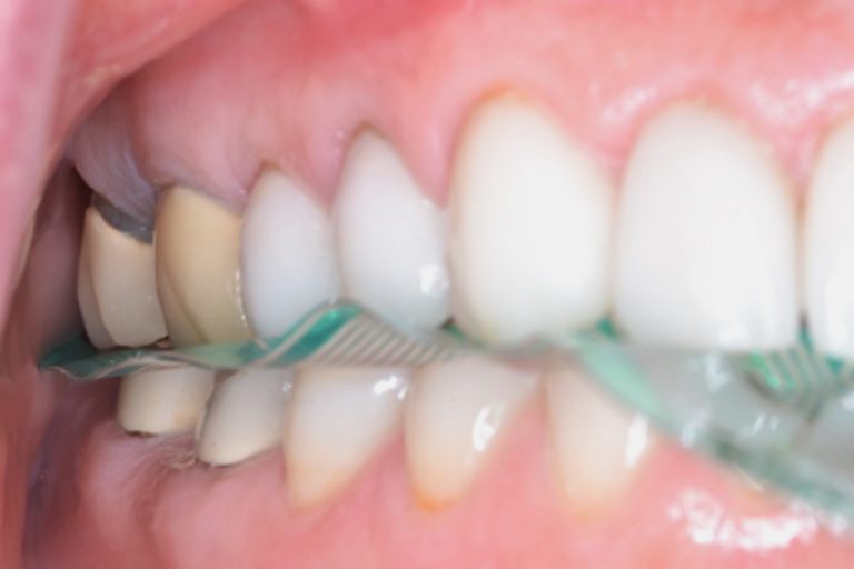 Utilizing digital occlusal indicators to increase occlusal accuracy and
