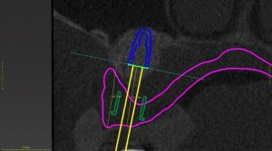 Interocclusal space assessment for full-arch implant-supported ...