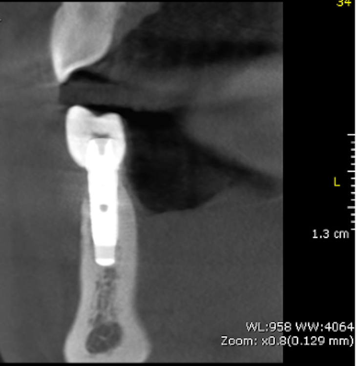 Radiographic signs of peri-implantitis: It is important to note that bleeding on probing, as one of the essential parameters in the diagnosis of peri-implantitis, determines the presence of inflammatory processes in the mucosa around the previously osseointegrated implant as well as radiographic bone loss