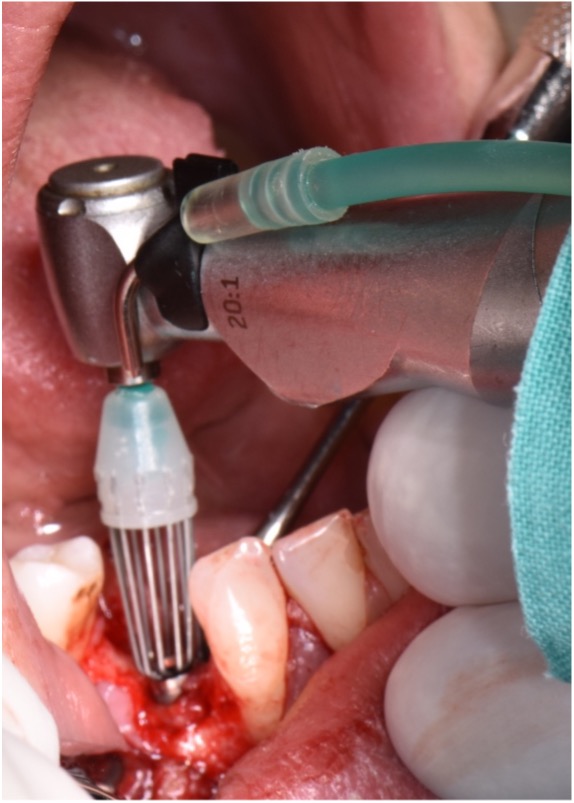 Mechanical implant surface decontamination by means of titanium brushes. To achieve complete pathogen elimination, it should be combined with adjuvant implant surface decontamination methods such as photodynamic laser therapy