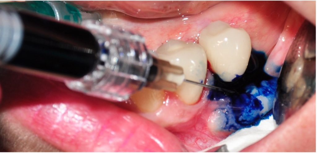 Photodynamic laser therapy: Application of photosensitizer (methylene-blue) in peri-implant pocket to dye specific microorganisms
