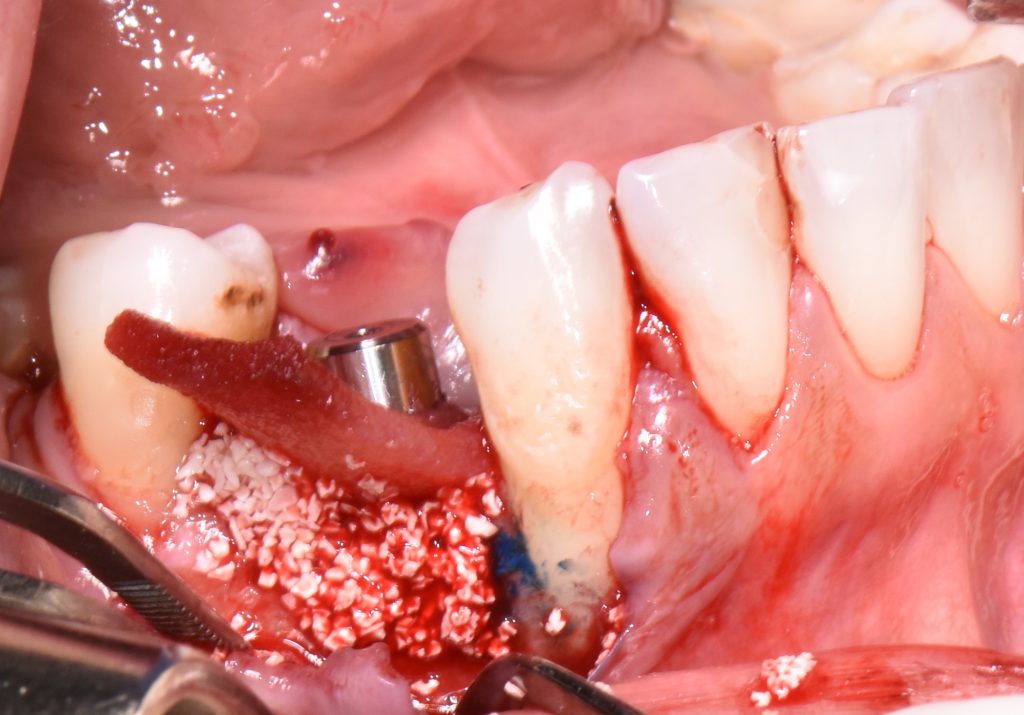 Regenerative peri-implantitis surgical therapy. Reconstruction of peri-implant bone defects by performing bovine bone substitute and collagen matrix