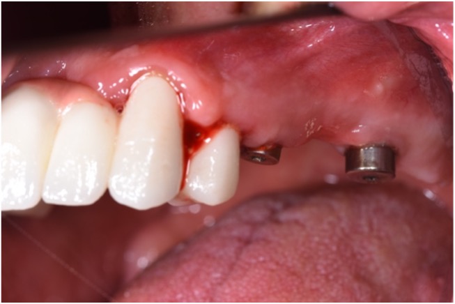Maintenance care is a very important step towards achieving long-term implant stability and successful outcomes. Photodynamic therapy can be considered an adjuvant treatment modality in peri-mucositis and peri-implantitis