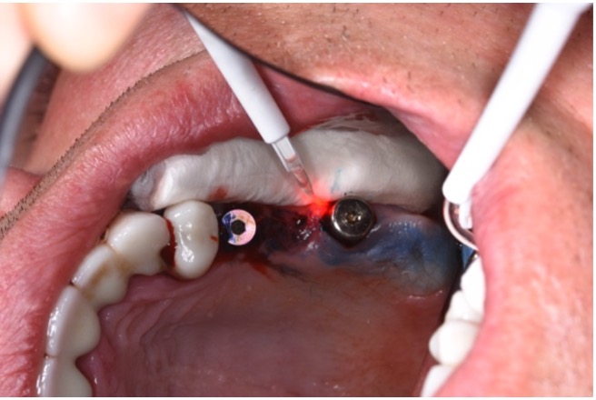 Maintenance care is a very important step towards achieving long-term implant stability and successful outcomes. Photodynamic therapy can be considered an adjuvant treatment modality in peri-mucositis and peri-implantitis