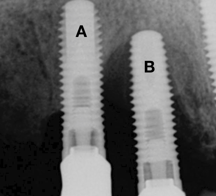 Peri-apical x-ray of an implant (A) with moderate bone loss at the distal aspect and advanced (>50%) bone loss at the mesial aspect and an implant (B) with bone loss close to the apex. Implant A is the distal implant of a 5-unit bridge and bears a cantilever and is thus strategically important. Implant B has extensive bone loss close to the apex and is strategically not important, thus making it irrational to treat and maintain