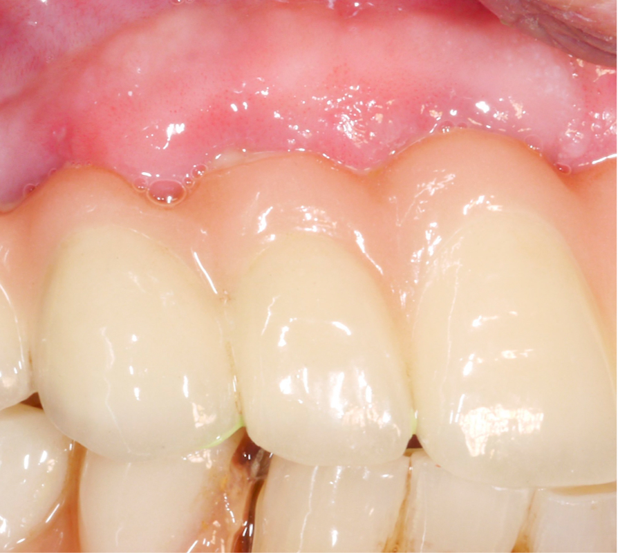 The design of the fixed implant-supported prosthesis impeded self-performed oral hygiene, and correct assessment of the probing pocket depth