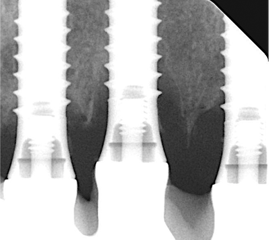 Peri-apical x-ray displaying incipient peri-implant bone loss at implants in position #11 and #13 and deeper intra-osseous defects at the implant in position #12