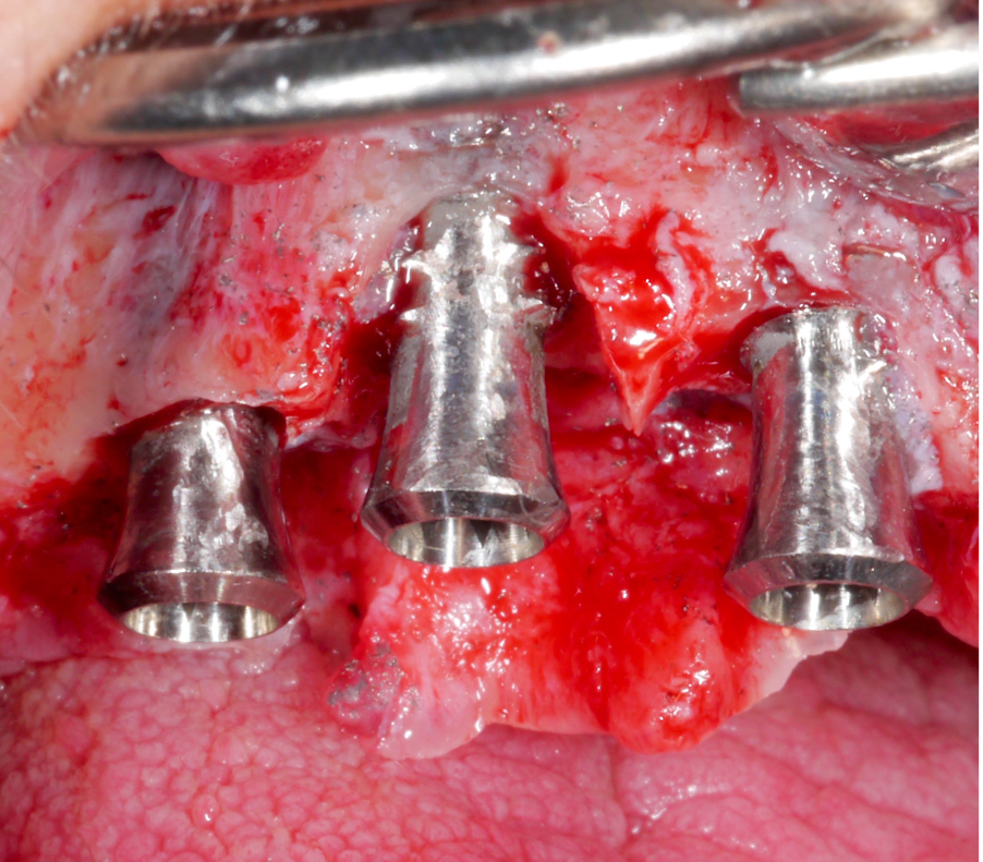 Implantoplasty was performed on the supra-osseous components and at the buccal and palatal dehiscences