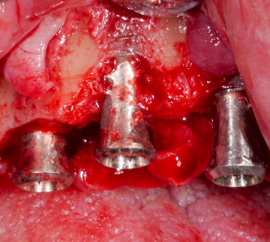 After surface disinfection, the intra-osseous defects were filled with autologous bone chips