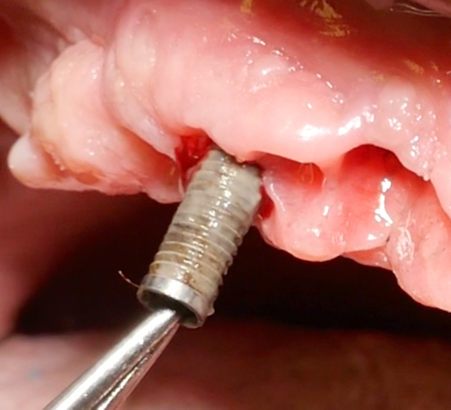 Explantation of the implant B in Fig. 1 with tweezers after removal of the supraconstruction; the implant had already lost osseointegration completely. Fig. 3: Removal of the implant supraconstruction helps to obtain more accurate clinical measurements (i.e., probing pocket depth, mucosal height) and improves access during non-surgical and surgical therapy