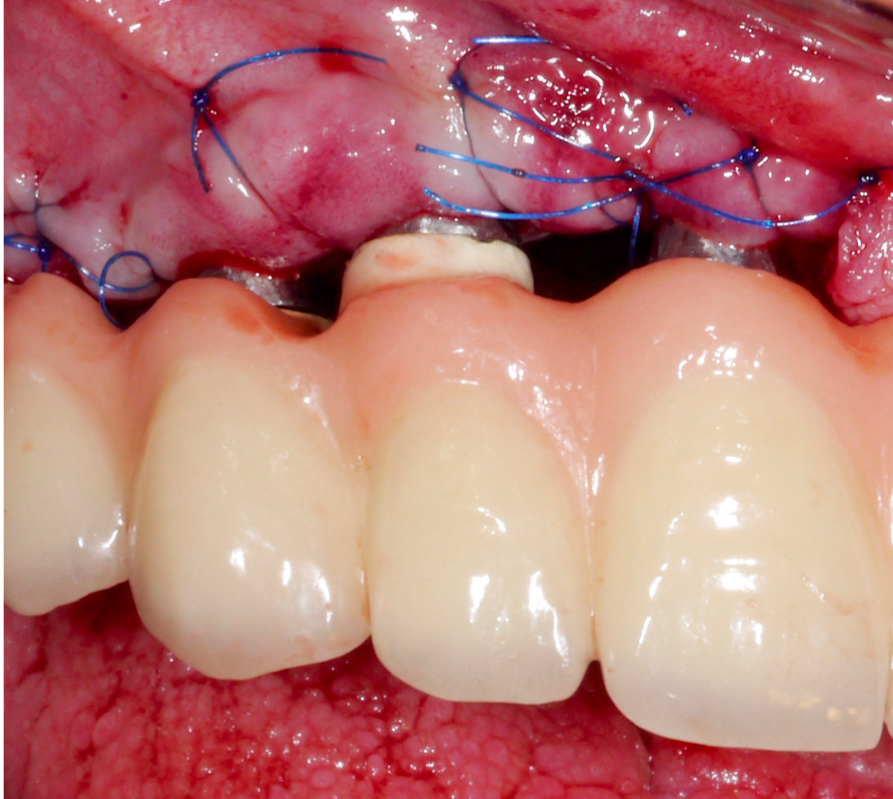 The low esthetic demands of the patient allowed trimming of the soft tissues and apical positioning of the flap, which in turn significantly improved access for self-performed oral hygiene