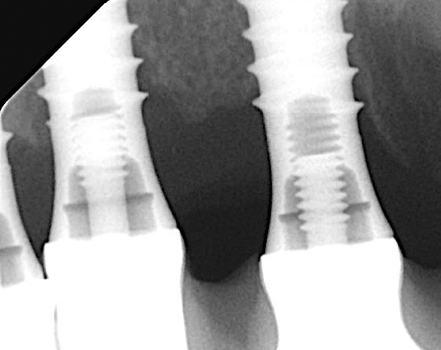 Radiographic outcome of implant #11 2 years post-operatively