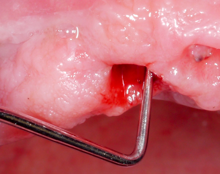 Removal of the implant supraconstruction helps to obtain more accurate clinical measurements (i.e., probing pocket depth, mucosal height) and improves access during non-surgical and surgical therapy