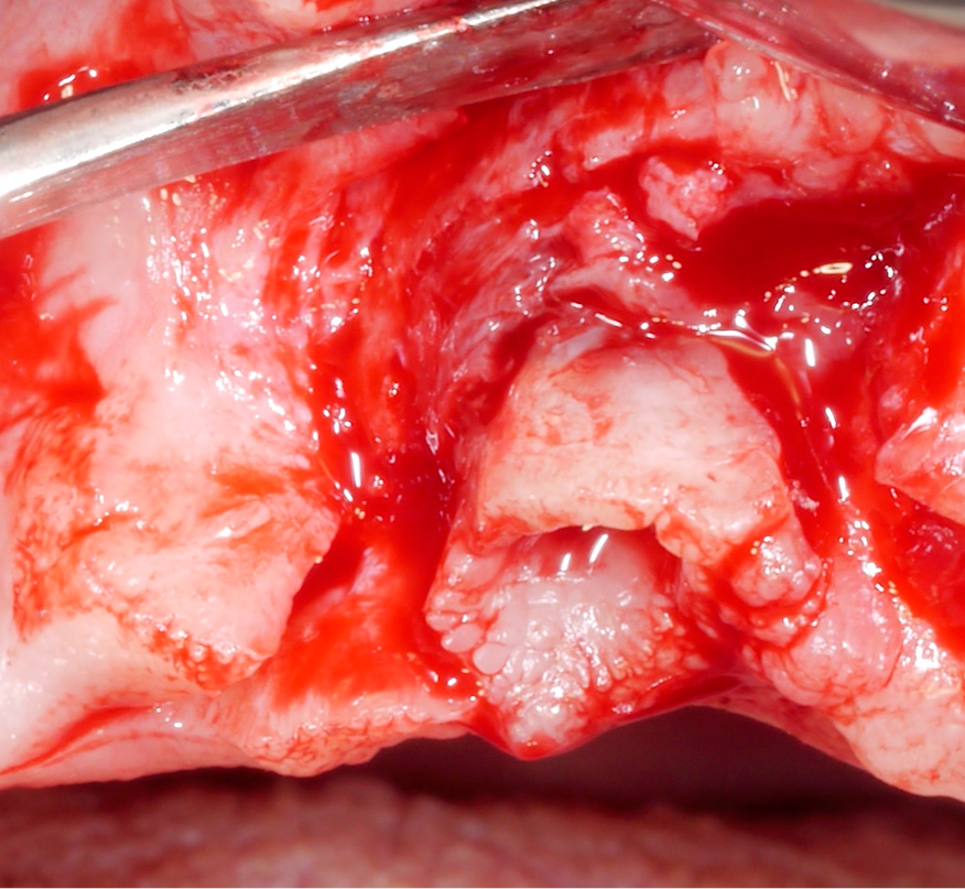 To reduce mucosal thickness, a paramarginal incision was performed followed by flap elevation