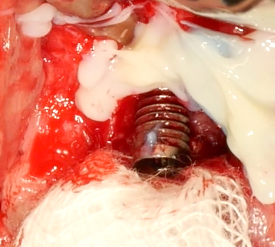 In this case, protection of the soft tissues from contamination from the titanium particles generated was achieved with a gauze (for the palatal flap) and light-cured liquid rubber dam (for the buccal flap)