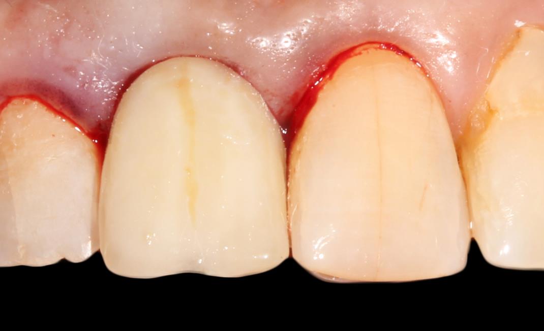 The Multi-purpose Abutment: The Use Of A Titanium Base Abutment As A ...