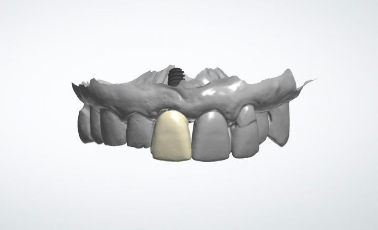 The Multi-purpose Abutment: The Use Of A Titanium Base Abutment As A ...