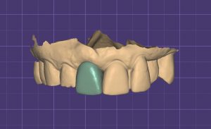 The Multi-purpose Abutment: The Use Of A Titanium Base Abutment As A ...