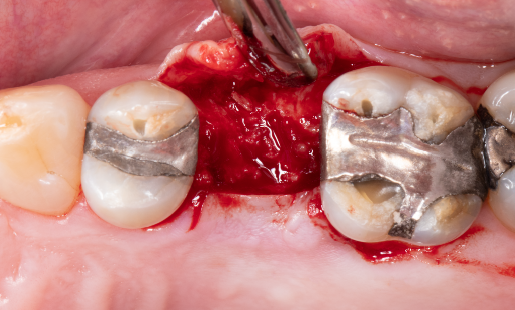 Bone reconstruction: (a) a full-thickness flap was elevated in