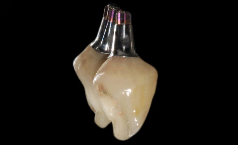 The Multi-purpose Abutment: The Use Of A Titanium Base Abutment As A ...