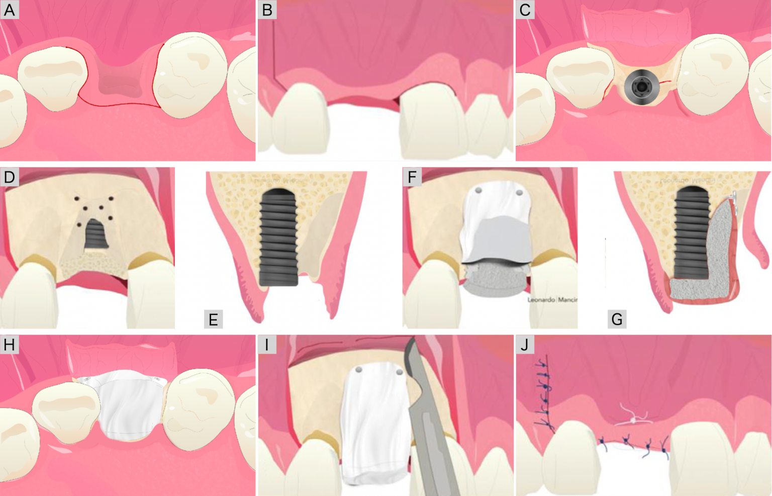 Lshape technique novel guided bone regeneration with simultaneous