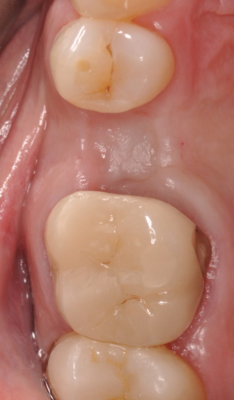The Devil Is In The Details Case Selection For Optimal Implant the-devil-is-in-the-details-case-selection-for-optimal-implant