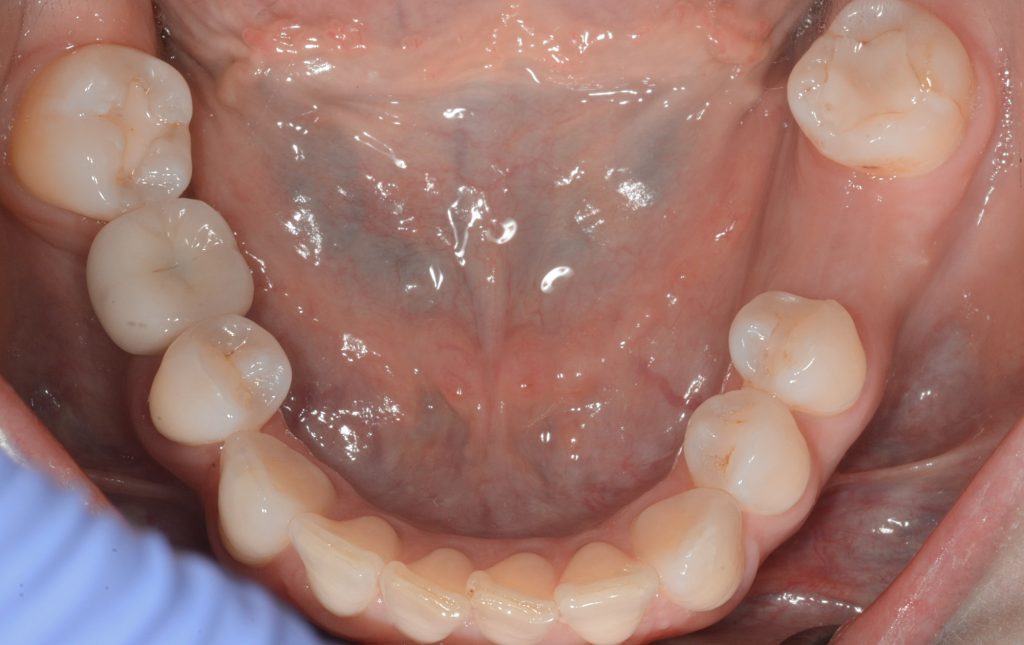 Fig. 1: Initial situation. Note the satisfactory oral hygiene, missing right mandibular first molar, and well-preserved residual ridge with adequate attached gingiva