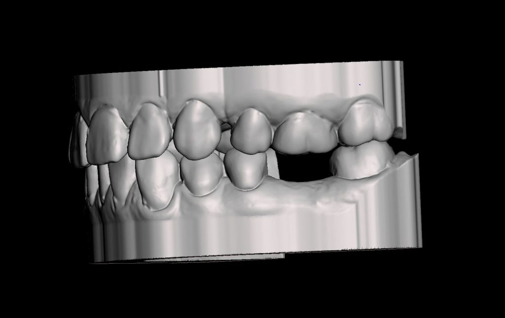 Figure 2: Standard Tessellation Language (STL) digital file of the maxillary and mandibular teeth in maximal intercuspal position (MIP)