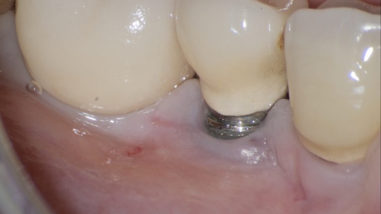 Trapezoidal Incision Hard- and soft-tissue deficiencies around dental implants: How to treat ...