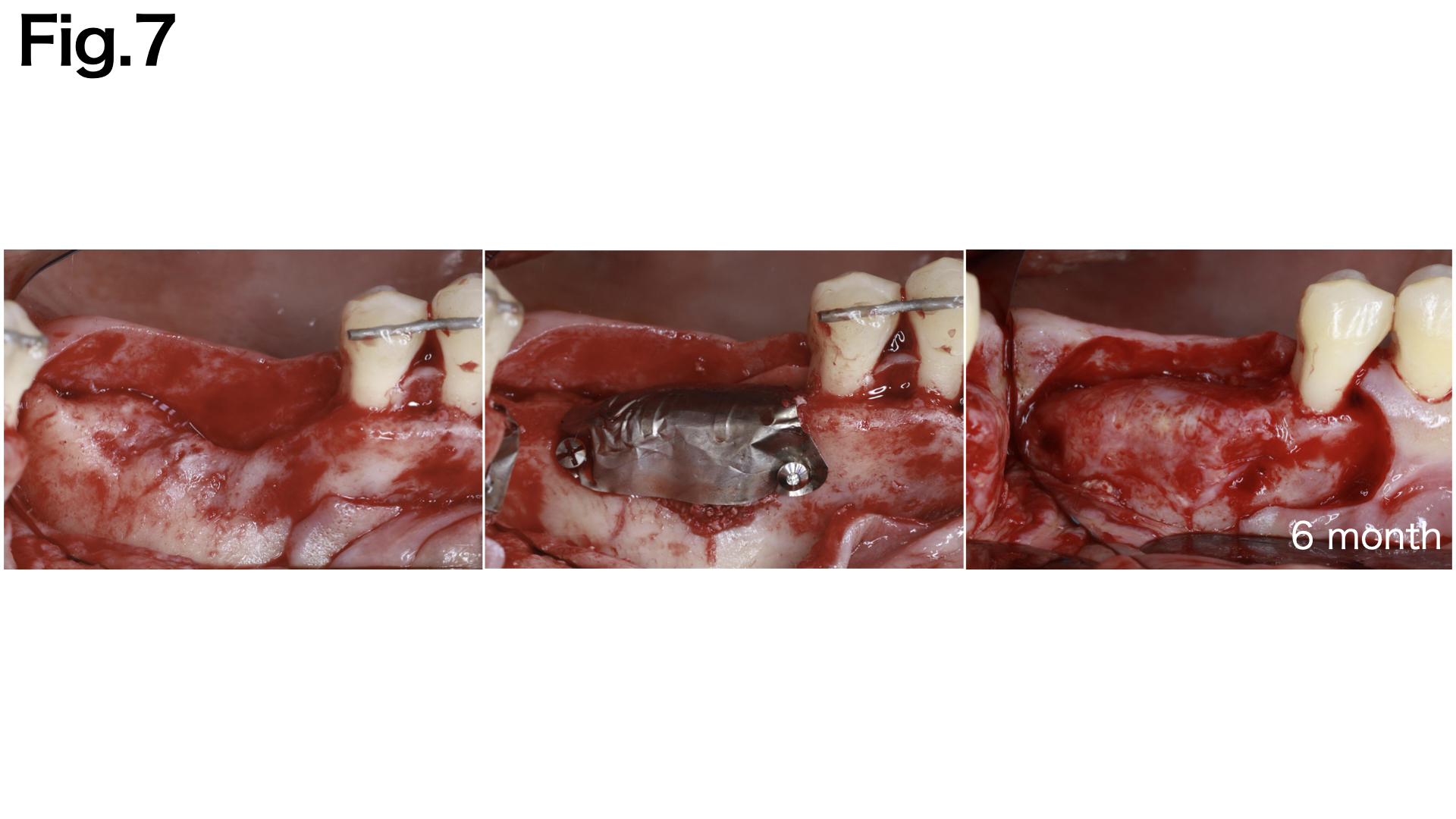 Photo inspiration: Morphology Defect Reduction Resin Reference: Bone Defect Morphology And Appropriate Barrier Membrane Selection