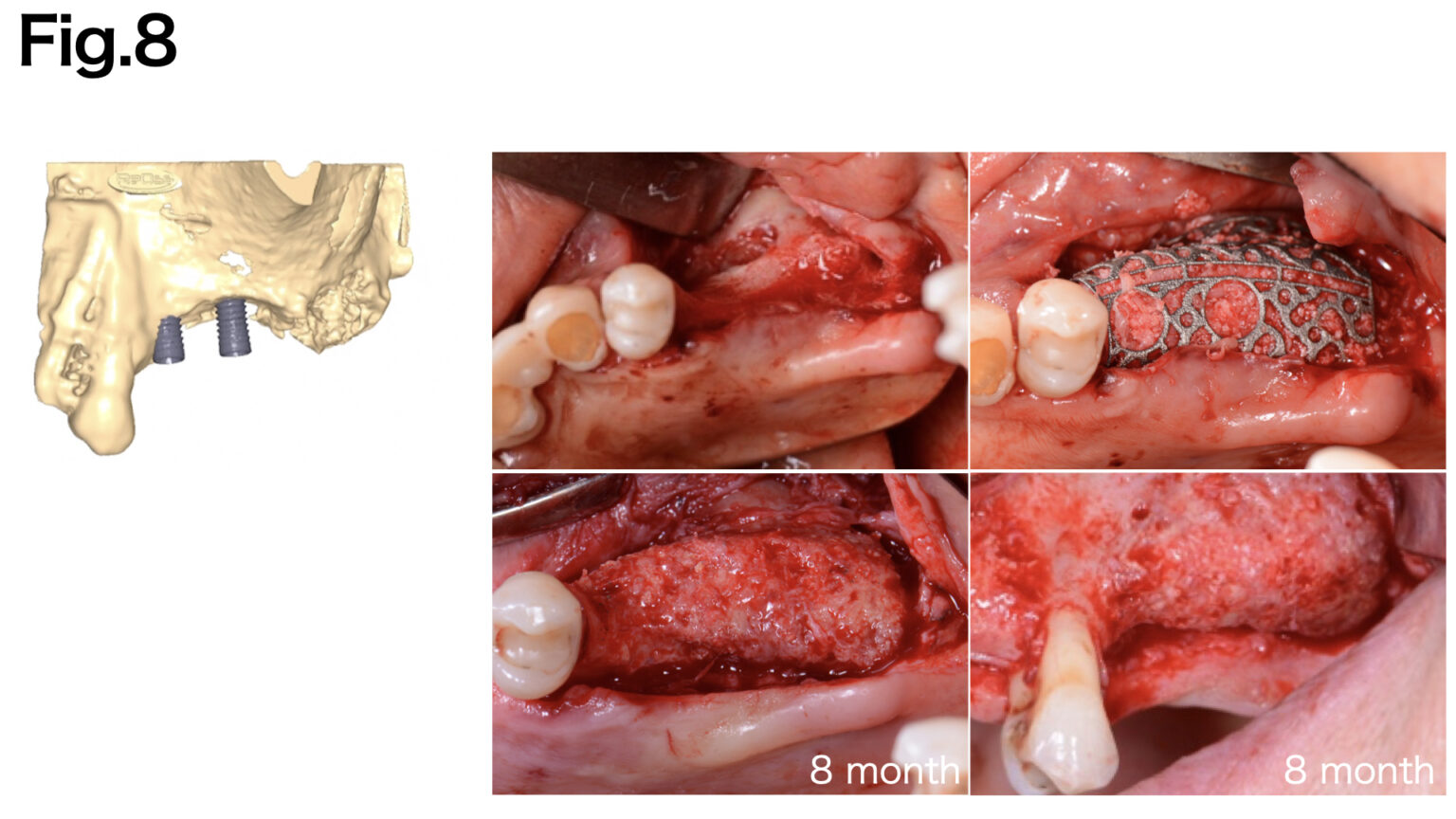 Bone defect morphology and appropriate barrier membrane selection - ITI ...