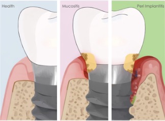Fig. 2: Schematic illustration of peri-implant tissues in health and disease